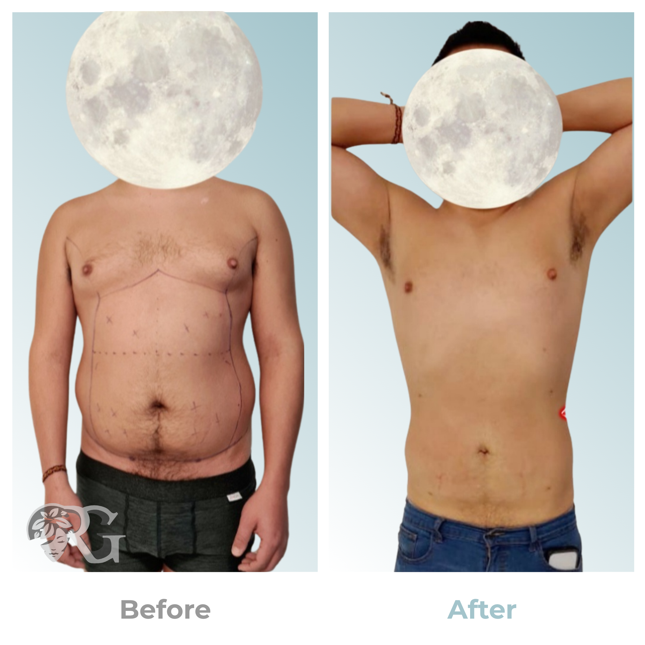 Before-after-hidrolipoclasia-lipo