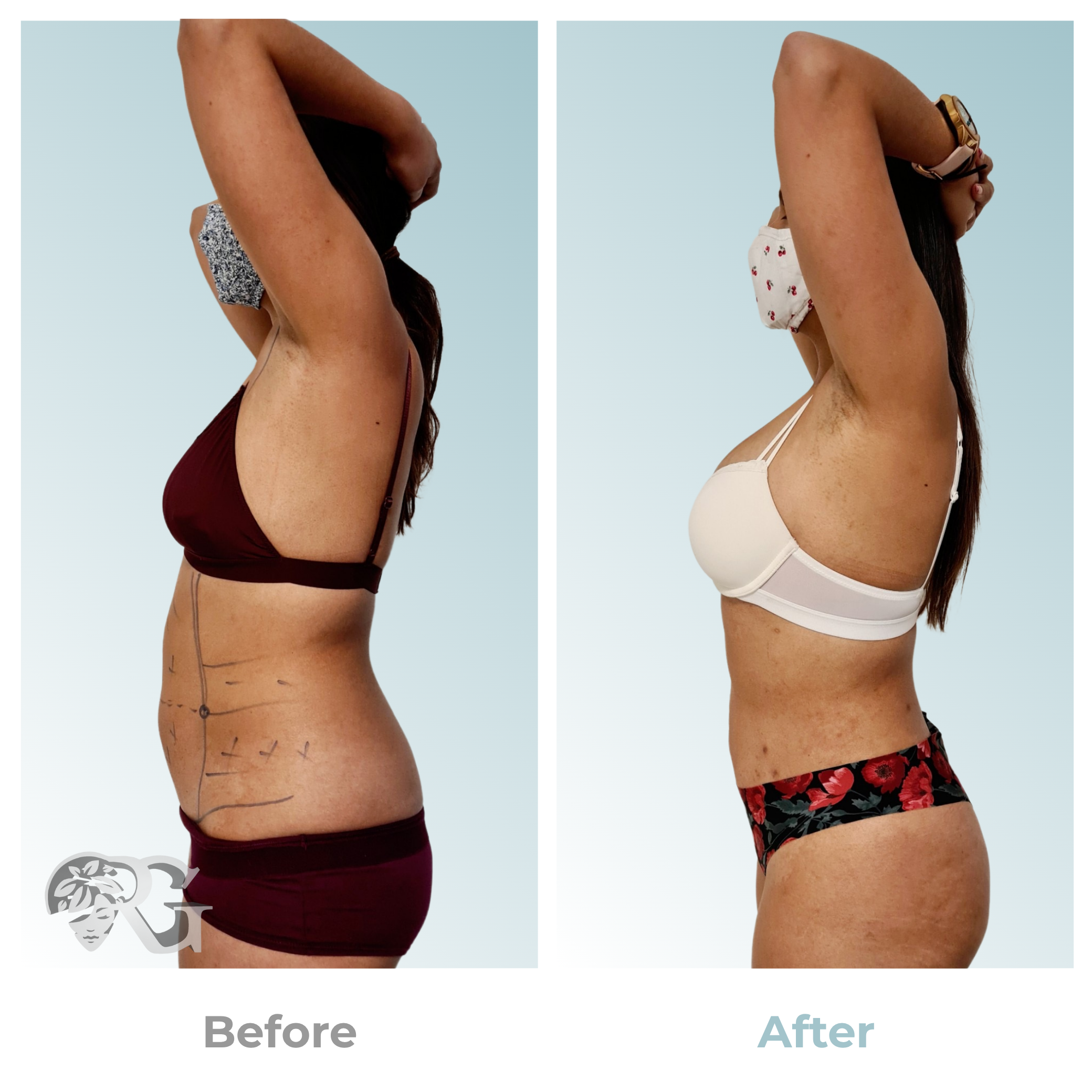 Before-after-hidrolipoclasia
