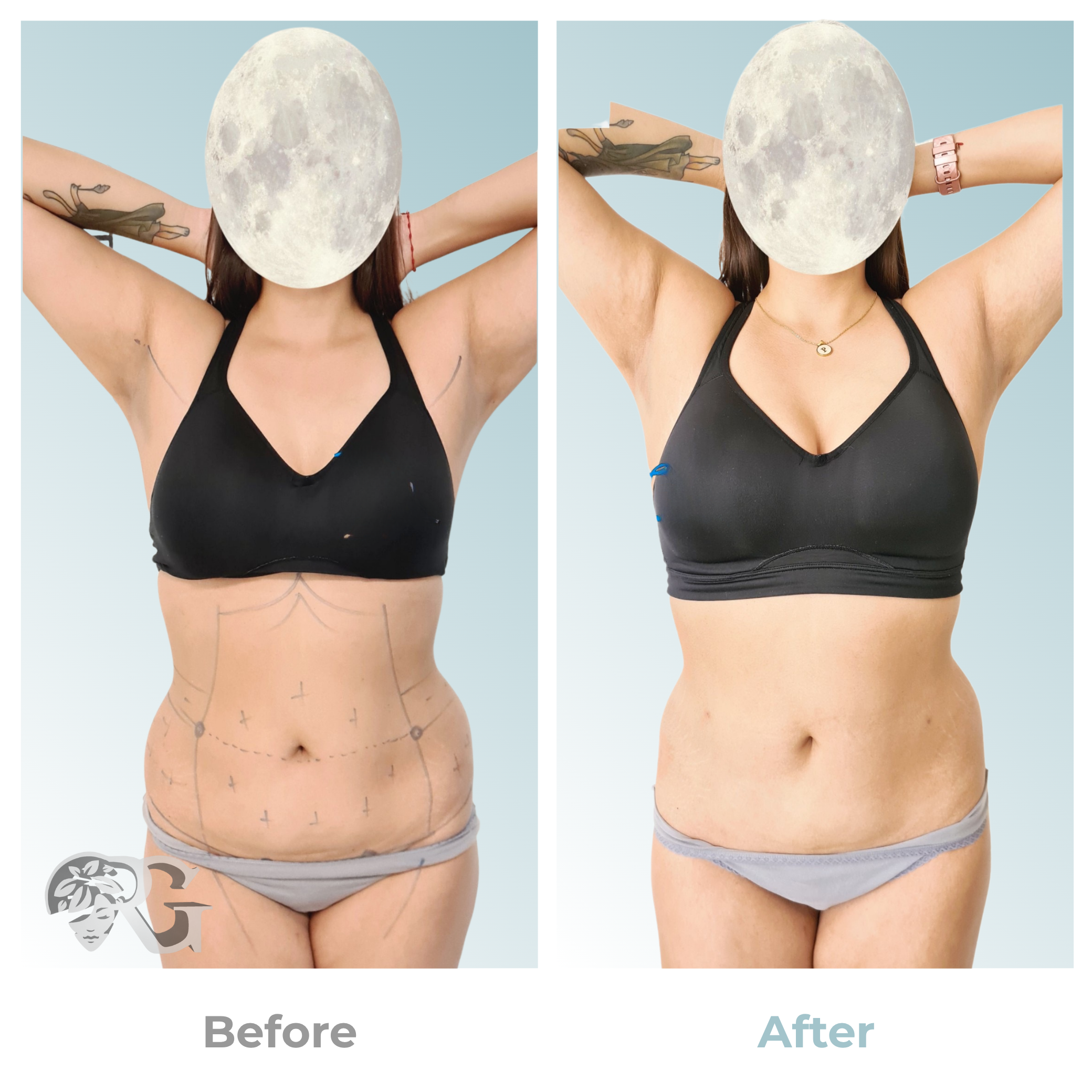 Before-after-paciente-hidrolipoclasia