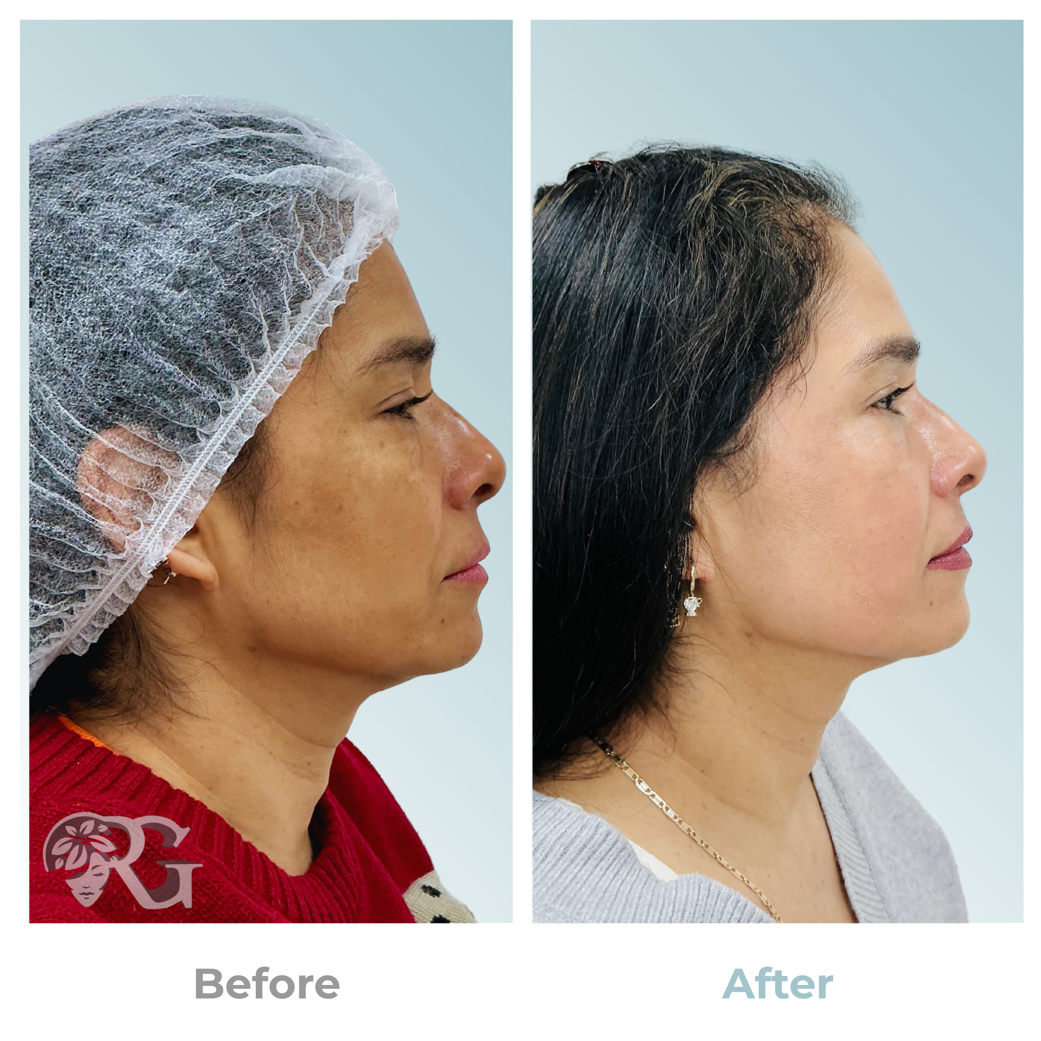 Before-after-paciente