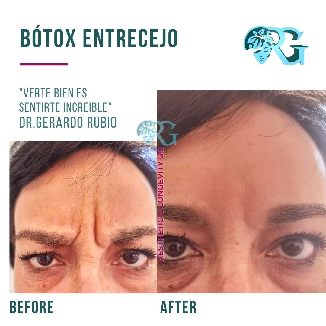 Botox-entrecejo-antes-y-despues-botoxx