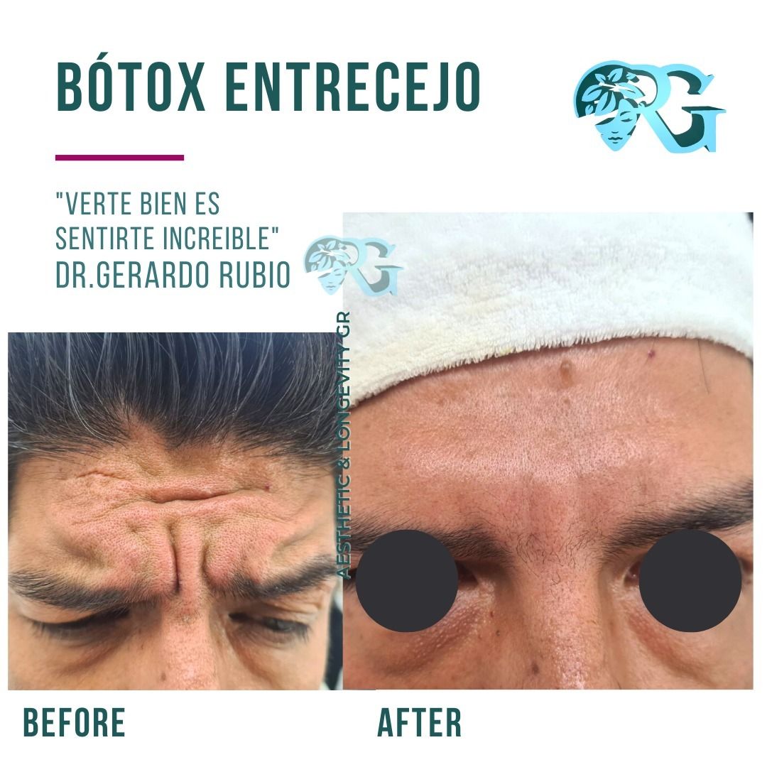 Botox-entrecejo-rostro-frente-hombre-paciente