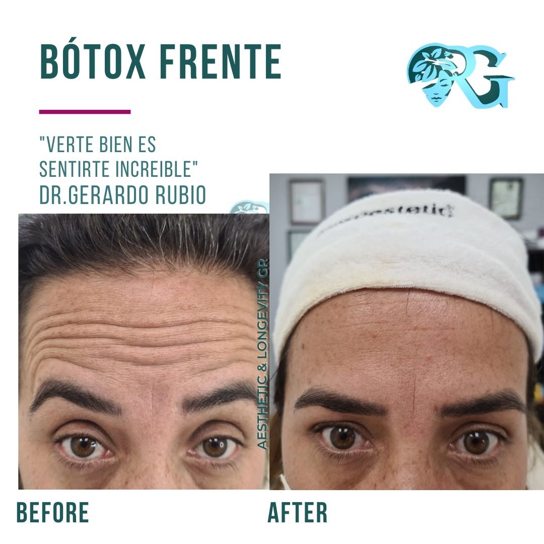 Botox-lineas-de-expresion-frente-antes-y-despues