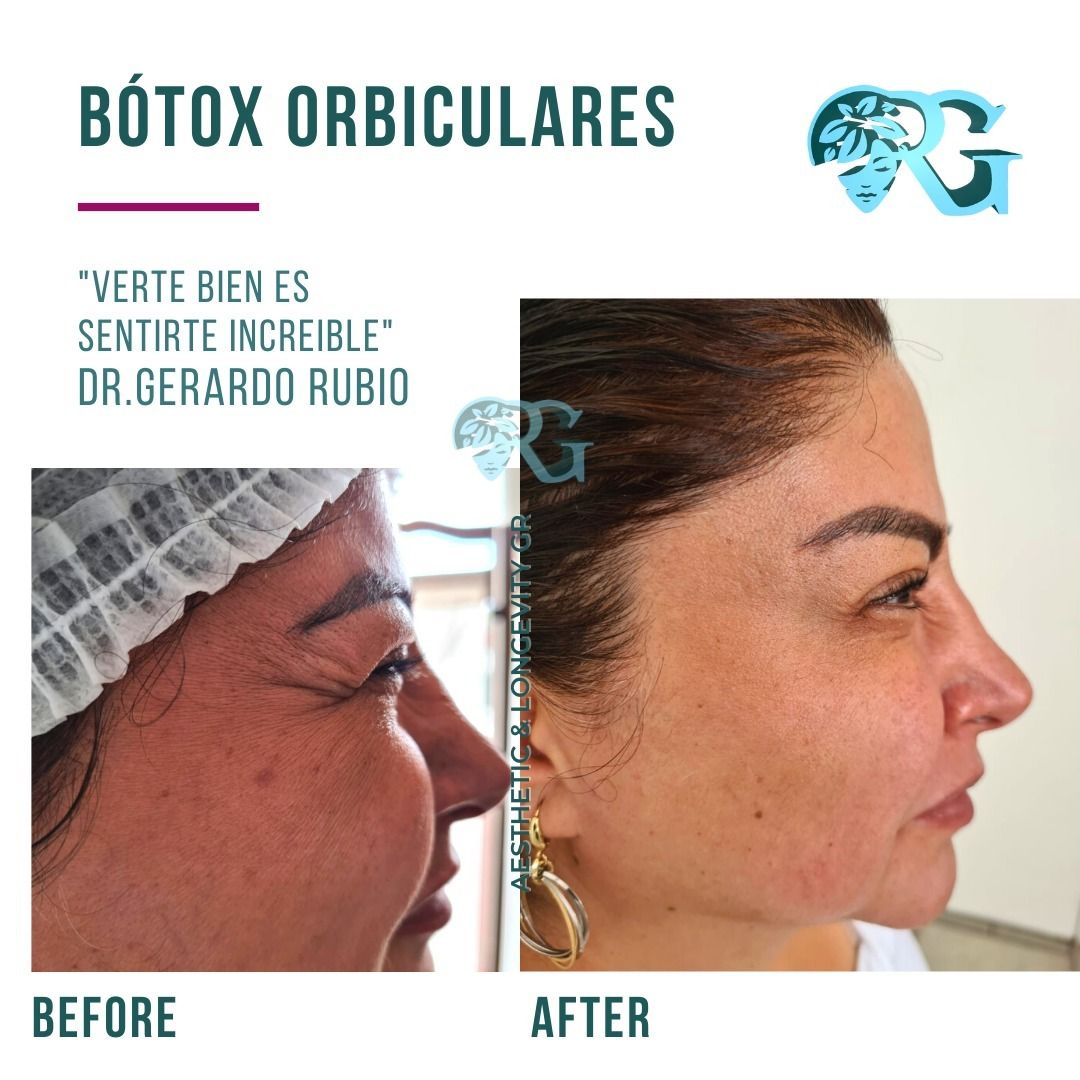 Botox-orbiculares-anntes-y-despues