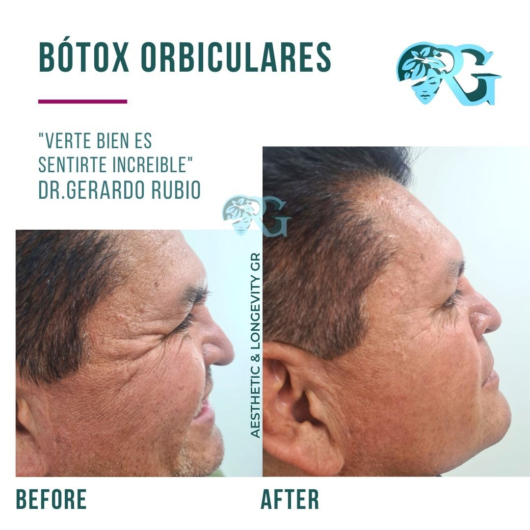 Botoxorbiculares-antes-y-despues