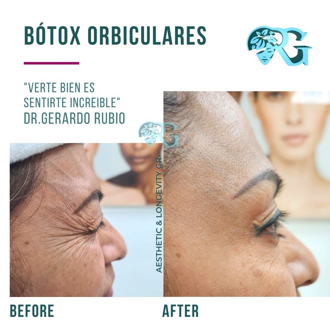 Botoxorbicularesantes-y-despues