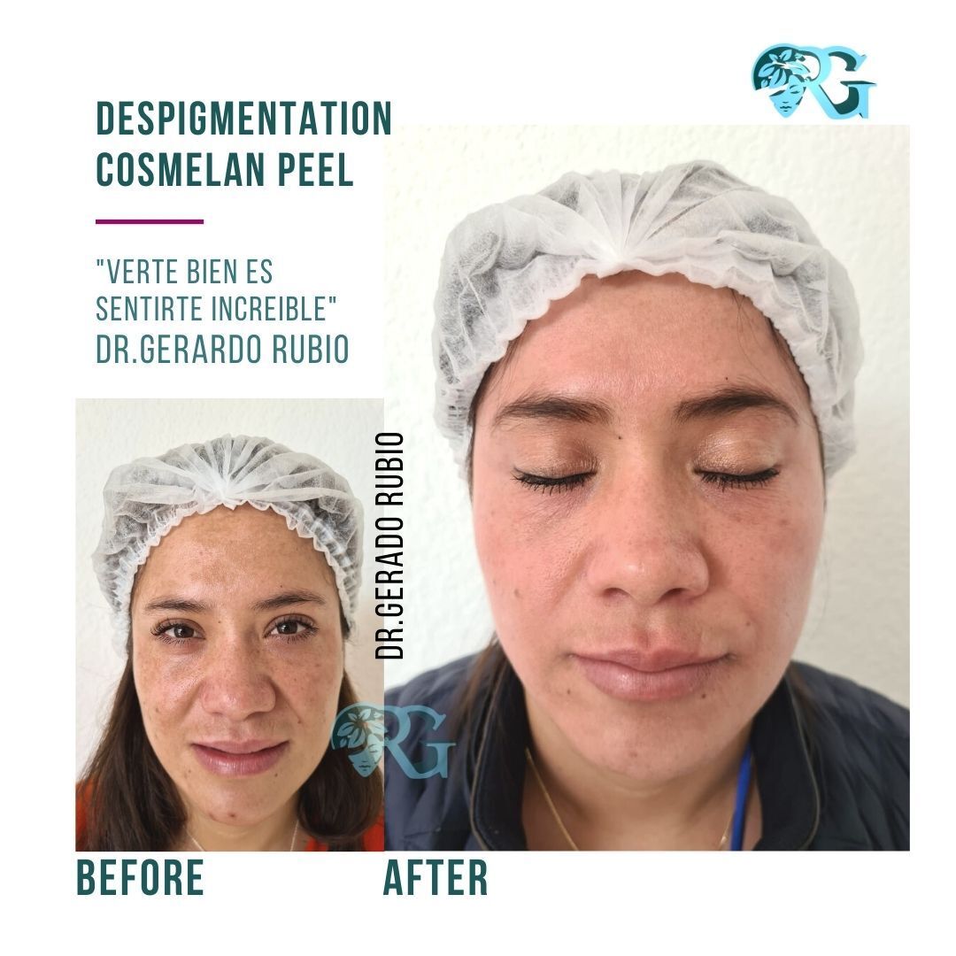 Despigmentante-cosmelan-peeling-rostro-mujer