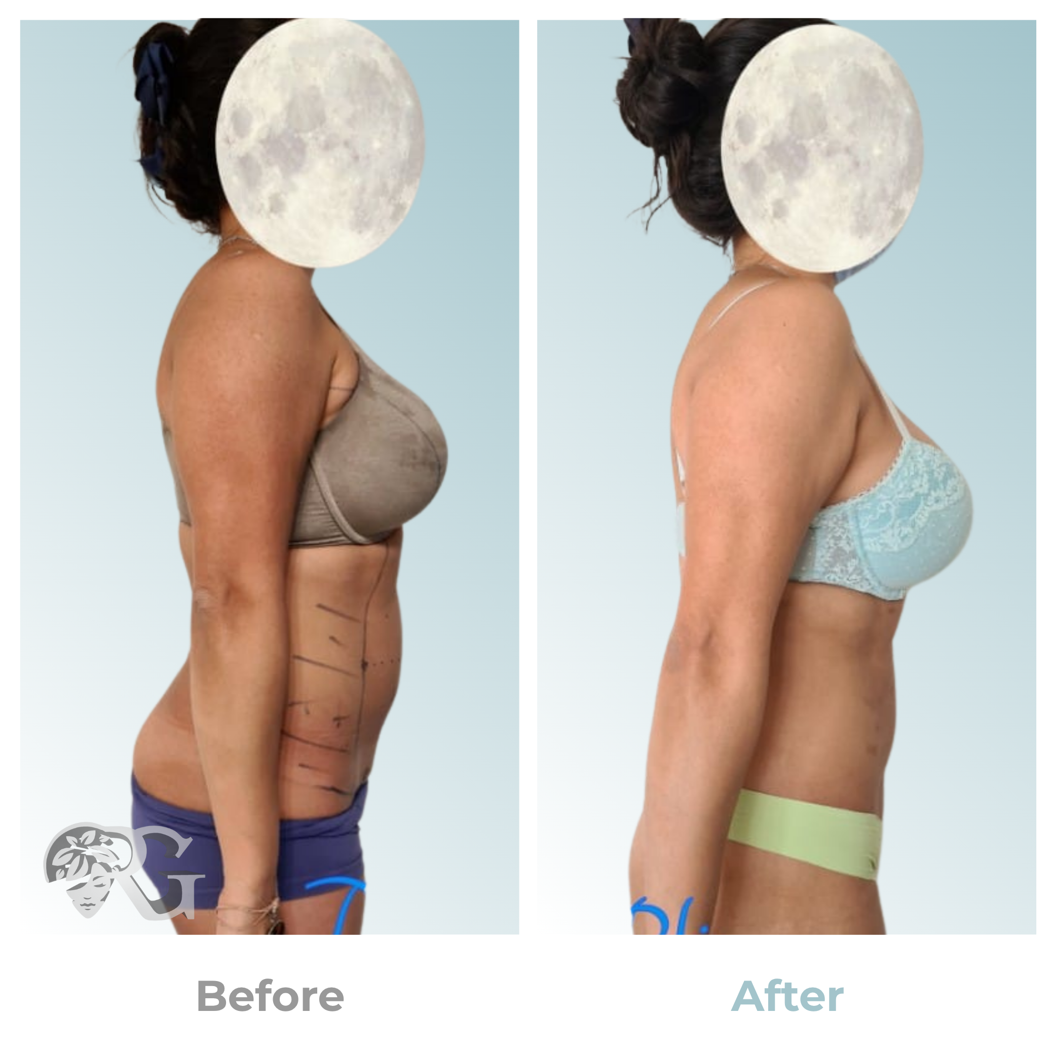 Hidrolipoclasia-cuerpo-antes-despues