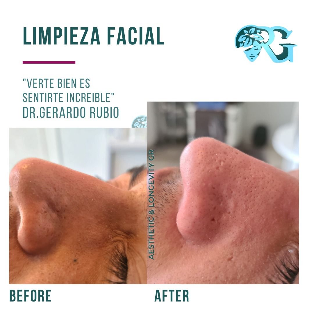 Limpieza-facial-before-after