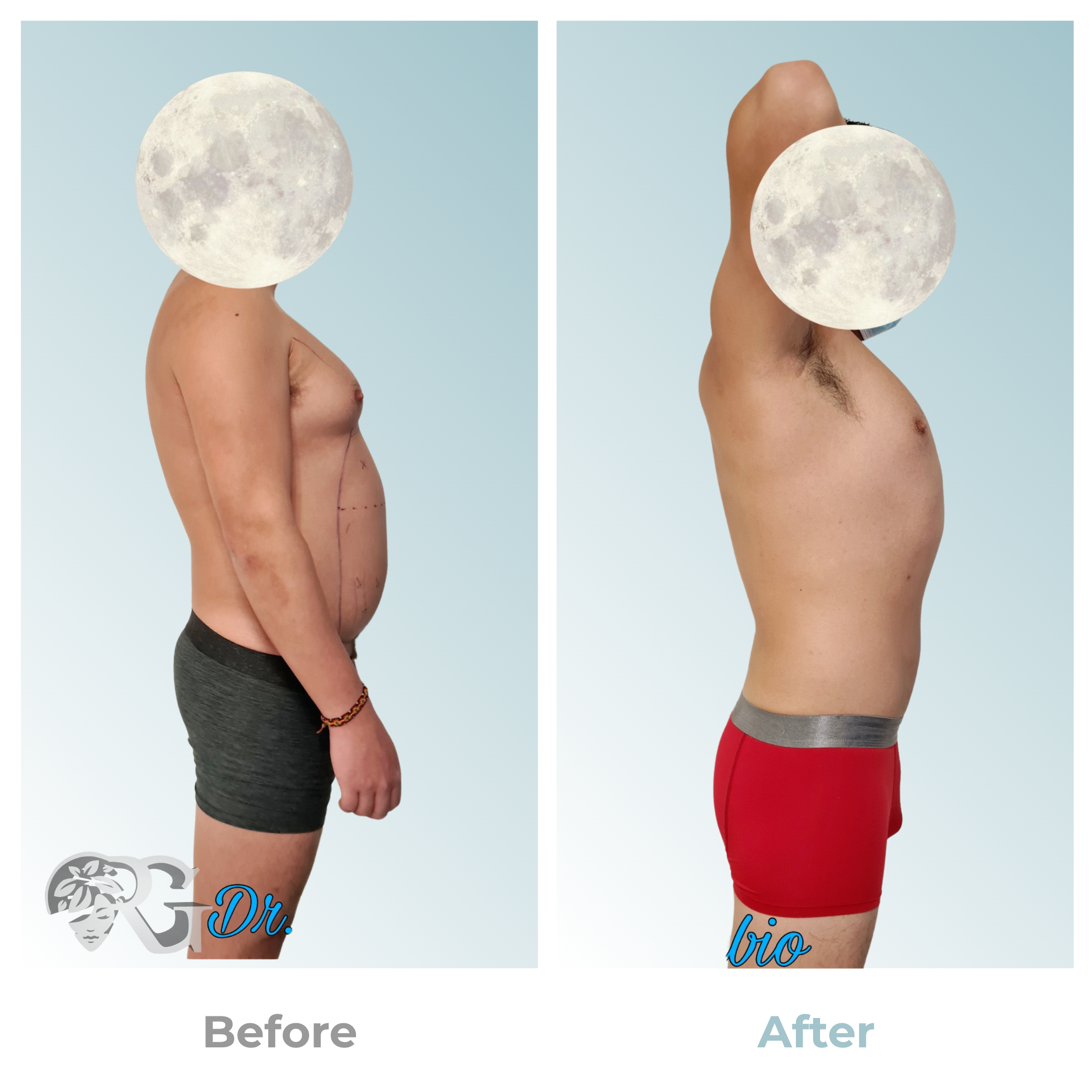 Minilipo-cuerpo-antes-despues-hombre