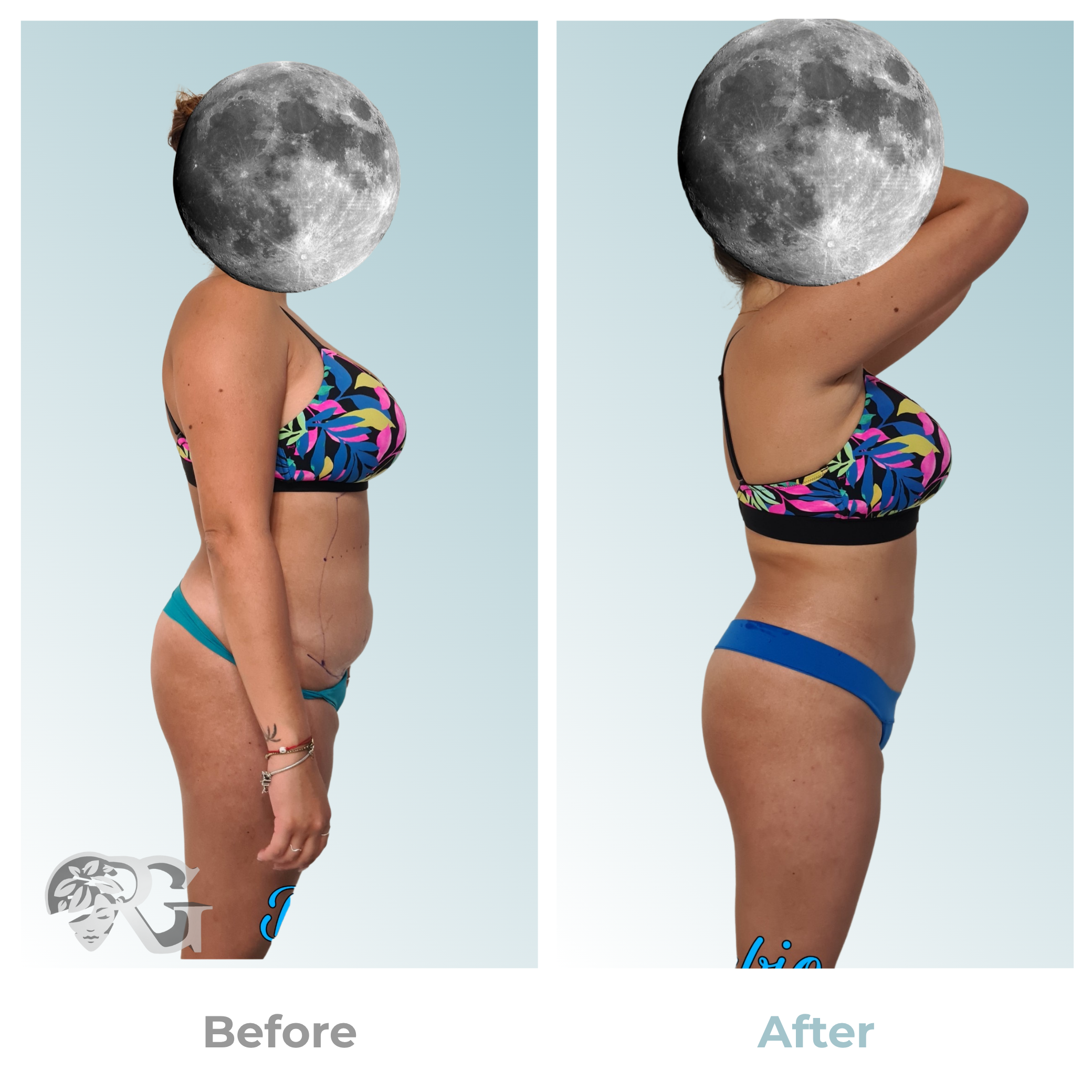 Minilipo-cuerpo-antes-despues