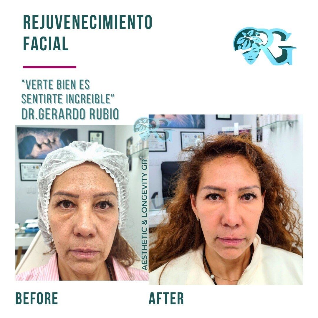Rejuvenecimiento-facial-rostro-before-and-after