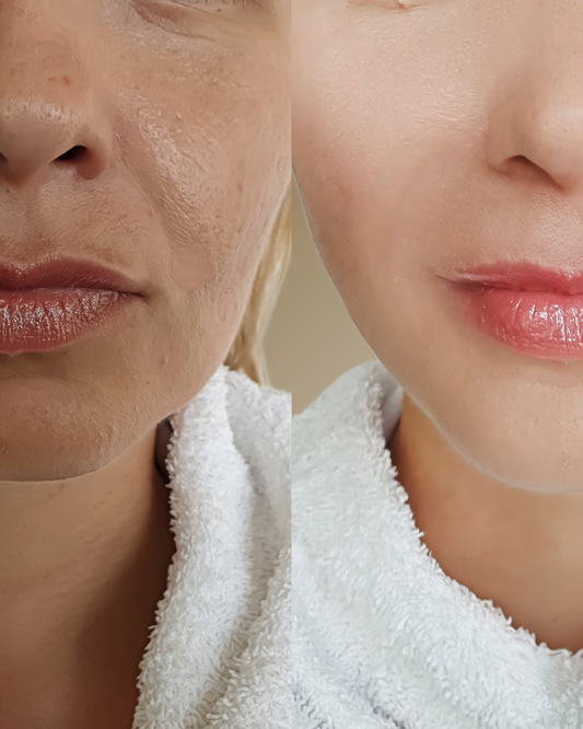 Cosmelan Peel By Mesoestetic