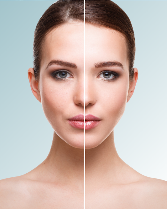 Exosomas-con-dermapen-exosomas-aplicados