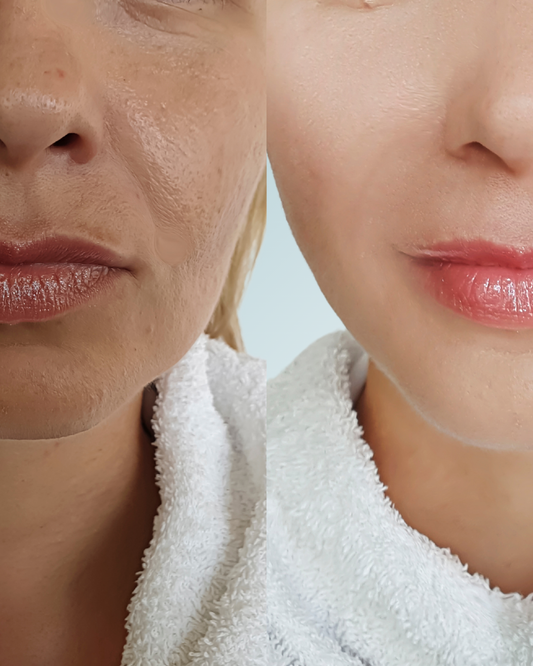 Cosmelan Peel By Mesoestetic